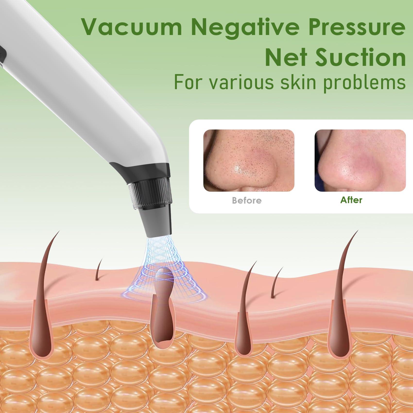 Blackhead Remover Vacuum - Black Head Remover for Face,Blackhead Extractor Tool with 3 Adjustable Suction Levels,4 Probes,USB Interface Type Pore Vacuum,Suitable for Women and Men (White) - Image 4