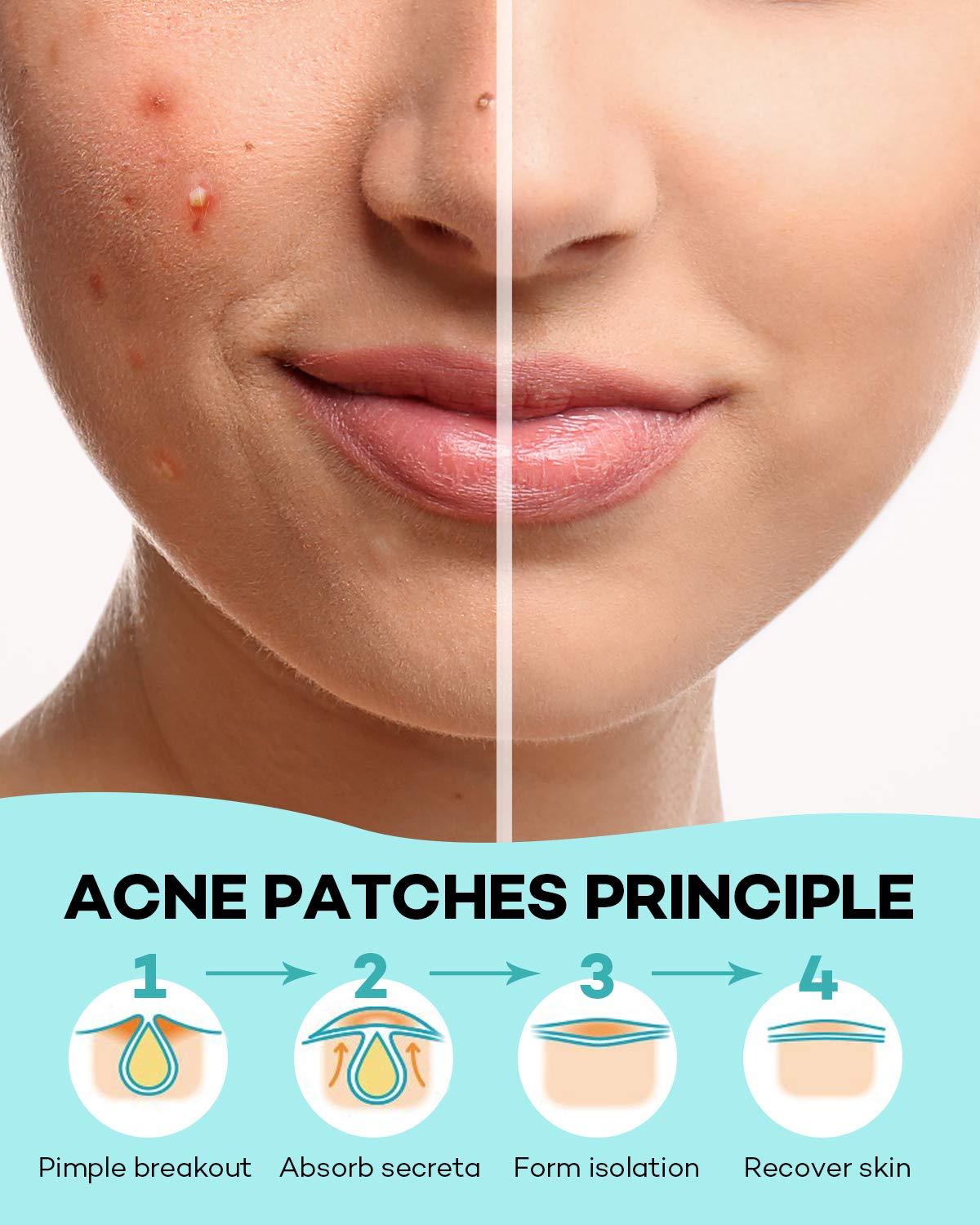 Pimple Patch Acne Patch, 4 Sizes 140 Patches Acne Absorbing Cover Patch, Hydrocolloid Invisible Acne Patches for Face Zit Patch Acne Dots Tea Tree, Calendula Oil - Image 6