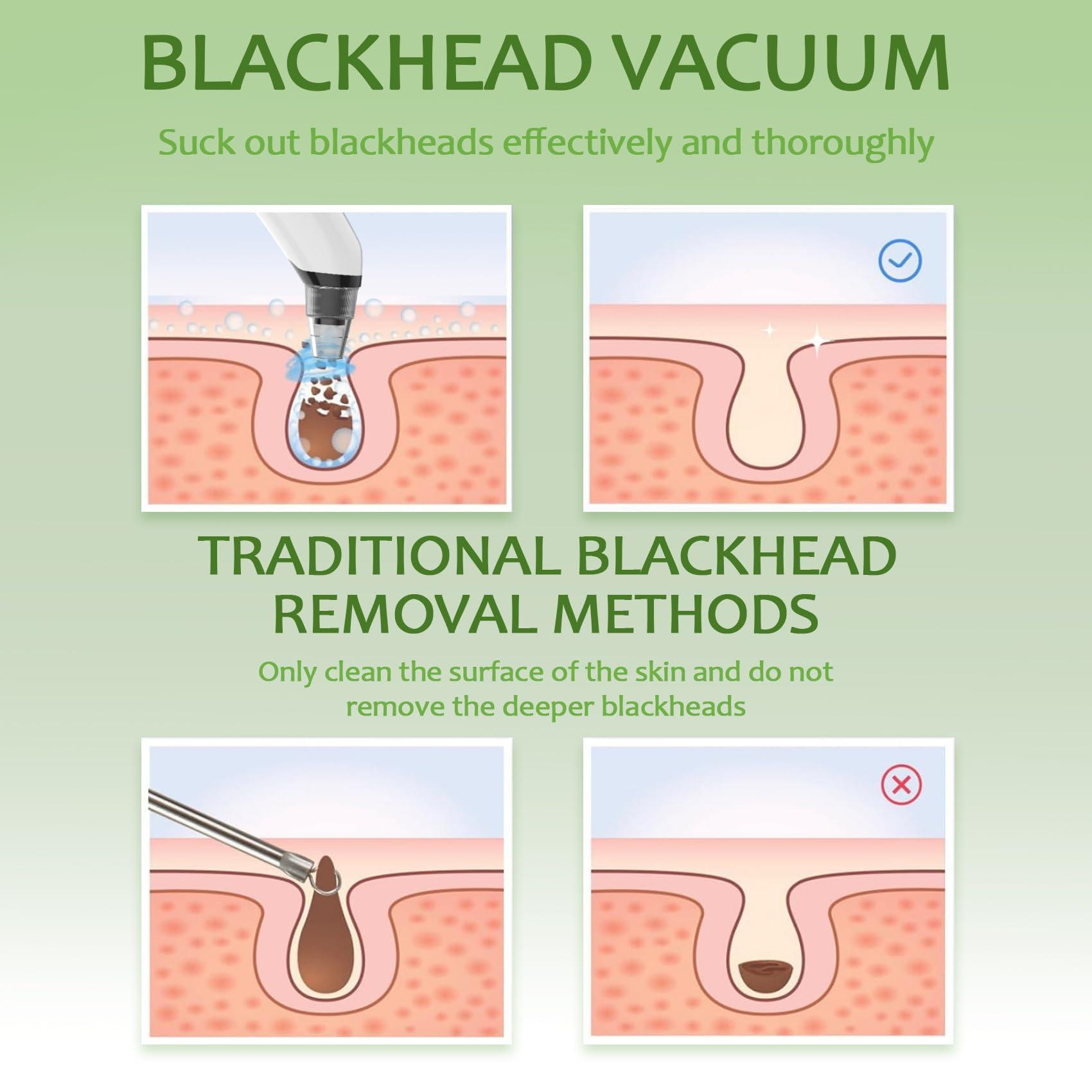Blackhead Remover Vacuum - Black Head Remover for Face,Blackhead Extractor Tool with 3 Adjustable Suction Levels,4 Probes,USB Interface Type Pore Vacuum,Suitable for Women and Men (White) - Image 7