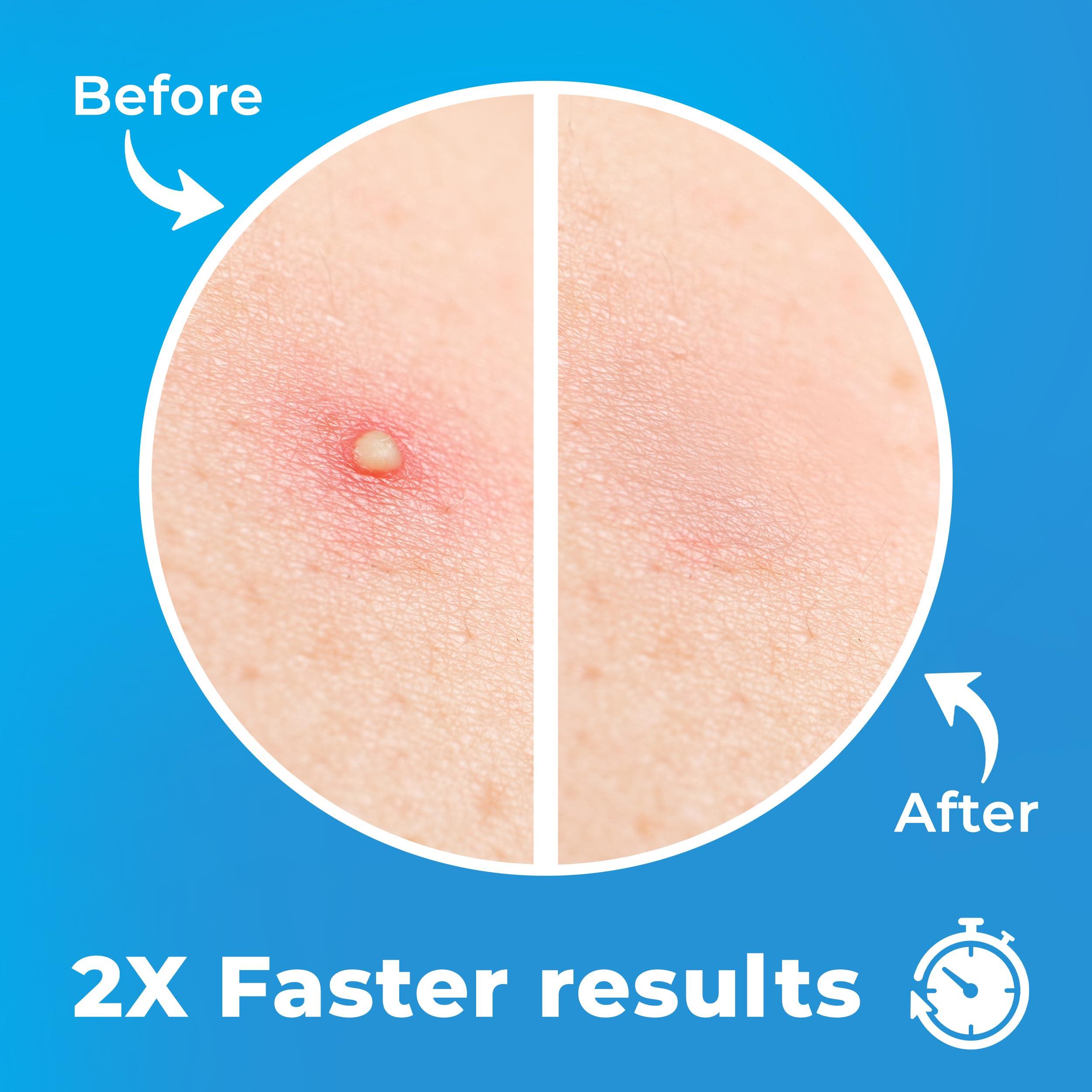 PatchRx Pimple Patches for Face (120 Patches), Hydrocolloid Acne Patches with Tea Tree Oil, Pimple Patch Pimple Stickers - Hydrocolloid Patch Acne Dots - Acne Pimple Patches For Face - Zit Patches - Image 3
